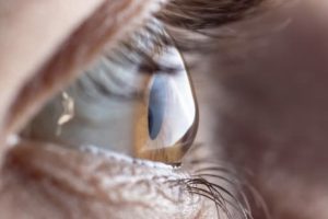 Trasplante de córnea: recupera tu visión