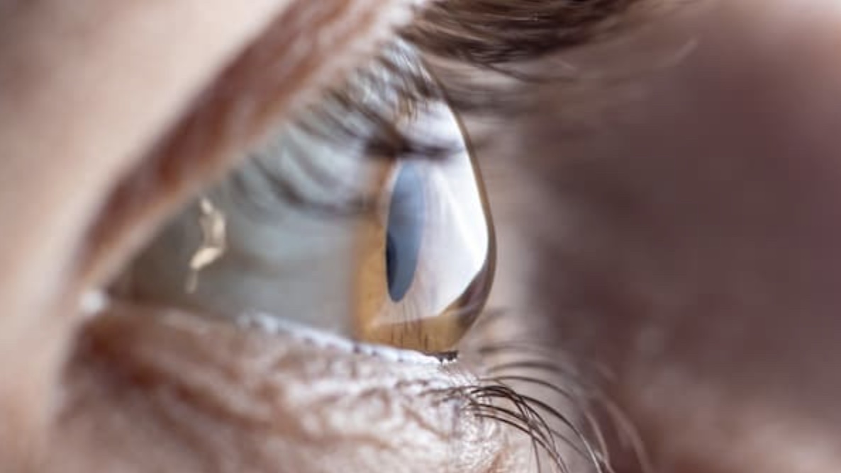 Trasplante de córnea: recupera tu visión